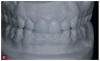 Fig 11. A diagnostic wax-up was created to guide the case and, in particular, placement of composite restorations on the mandibular anterior teeth and posterior teeth.
