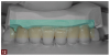 Fig 12. The diagnostic wax-up enabled a solution-driven preparation, as it indicated where the teeth would ultimately be positioned.