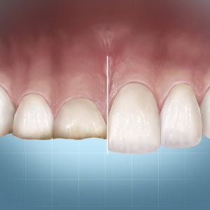 Minimally Invasive Restoration of Worn Dentition: Understanding “Complete Dentistry” Concepts eBook Thumbnail