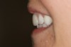 Figure 17  The 90¬∞ smile photograph of case two. The trajectory of the incisal edges is too far to the labial.