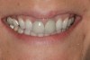 Figure 20  The 1:3 full smile of case two. Note the dominance of the central incisors, poor anterior occlusal plane, and displeasing position of the gingival zeniths.