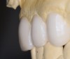 Figure 22  In the diagnostic phase, care was taken to create idealized contours and emergence profiles even on the wax-up. This will allow accurate provisionalization and transfer of information to the laboratory.