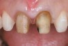 Figure 28  The final preparations of case two. Note the extremely dark dentin associated with the central incisors.