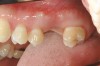 Figure 1  Replacement of a missing tooth has long been a treatment objective to improve oral health and function.