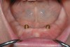 Figure 5  Locator abutments placed on implants can also be used for an implant-assisted prosthesis.