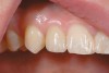 Figure 16  Replacement of the maxillary lateral incisor with a CAD/CAM zirconium abutment and a zirconium/ceramic crown.
