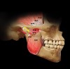 Figure 5  Occlusion hit and slide can create muscle incoordination when occluding.