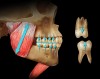 Figure 3  Teeth erupt until the eruptive force is stopped by an equal opposite force. This force occurs at the jaw-to-jaw position that is determined by a consistent, repetitive contracted length of the elevator muscles. The eruptive force is present throughout life. Eruption can be stopped short of tooth contact by tongue position, habits such as thumb sucking, or occlusal appliances. Teeth erupt until something stops them.