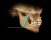 Figure 4  VDO occurs at maximum intercuspation, regardless of condyle position. A down-forward displacement of the condyles can result in an upward positioning of the anterior mandible.