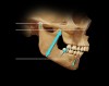 Figure 5  If displaced condyles are seated upwardly to CR the tendency is to shorten the zygoma-to-mandible distance. This shortening often occurs with an increased dimension at the anterior mandible. In such situations, the anterior face can be lengthened without interfering with muscle contraction length. This produces an increase of VDO for the anterior segment that can remain stable.