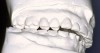 Figure 7a  Casts mounted in CR and closed to the first point of contact. Note the buccolingual relationship of the posterior teeth as well as the lack of contact for the anterior teeth. Reshaping the posterior teeth to allow closure to anterior contact in CR can determine accurately the VDO that is ideal for both vertical and horizontal positioning of the lower incisal edges in relation to the upper anterior teeth, an essential determination for predictable treatment planning.