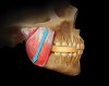 Figure 8a  The typical result from segmental posterior biteraising appliances. When teeth interfere with muscle contraction length by means of a segmental appliance, the covered teeth are intruded while the uncovered dentoalveolar segment elongates because the appliance separates it from opposing contact until eruption is stopped against opposing teeth.