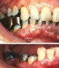 Figure 8b  Classic example of the stepped occlusion resulting from posterior segmental bite-raising.