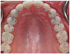 Fig 1. In complete dentistry, centric stops on all teeth create equal intensity bilateral contacts.
