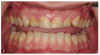 Fig 7. A man presented with significant tooth surface loss and a desire for an esthetic smile makeover but with minimally invasive treatment and as little tooth preparation as possible.