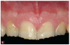Fig 8. Preoperative photographs were taken as part of the evaluation process, including a close-up view of the maxillary central incisors demonstrating the extent of wear.