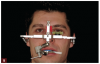 Fig 9. Restoring function and establishing a stable occlusion would be paramount, so records included a facebow transfer.