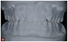 Fig 10. A preoperative study model was poured for evaluation and to guide placement of restorations to establish the ideal occlusion.