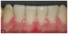 Fig 13. View of the anterior mandibular pre-evaluative provisional restorations, which could be prepared to ensure as minimal tooth removal as possible.