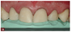Fig 14. A guide was made from the diagnostic wax-up for use in creating pre-evaluative provisionals for the anterior maxillary dentition.