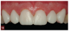 Fig 15. View of the anterior maxillary pre-evaluative provisional restorations.