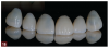 Fig 16. In this case, the chosen restorations were v-shaped taco shell veneers that enabled maintenance of the contact points and preservation of the enamel and maintained the tooth’s flexural strength.