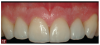 Fig 17. The result of the minimally invasive, complete dentistry approach to treating the patient’s worn dentition was an esthetic, natural-looking outcome, which the patient had desired.