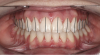 Figure 3  There is a mesial inclination of the maxillary teeth from gingival to occlusal in the esthetic dentition. Maxillary posterior teeth have an axial inclination which converges from the gingival through the occlusal toward a central fulcrum.