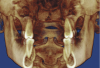 Figure 4B  Coronal section of 3D tomograph revealing axial alignment of posterior teeth. A) Dental alignment does not allow occlusal forces to be directed down long axis of teeth. Maxillary teeth had been tipped to the buccal to compensate for the transverse discrepancy. B) Teeth are positioned to allow occlusal forces to be directed down long axis of teeth.