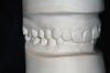 Figure 7A  This case is an example of the importance of evaluating the bite with the joints seated in a stable position. Orthodontic treatment was rendered to correct a 