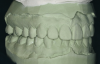 Figure 7B  This case is an example of the importance of evaluating the bite with the joints seated in a stable position. Orthodontic treatment was rendered to correct a 
