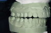 Figure 7C This case is an example of the importance of evaluating the bite with the joints seated in a stable position. Orthodontic treatment was rendered to correct a 