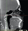 Figure 9A  An example of orthodontic and orthognathic surgery being performed without adequate goals. A) The maxillary central incisors were positioned with severe protrusion. The tooth has been moved through the cortical bone, has forces directed nearly perpendicular to the long axis, and shows evidence of root resorption.