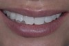Fig 9. After whitening has been completed, the patient was ready for the composite restorations, which will address the fracture lines and the multicolored pre-existing condition.