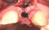 Fig 21. A dental implant was placed at the site of tooth No. 10. A defective buccal ridge was noted.