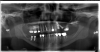 Fig 7. A panoramic radiograph is an effective diagnostic tool; however, distortions occur, and artifacts may appear.
