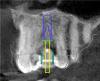 Fig 8. Superimposition of digital scan over the CBCT.