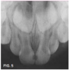 Fig 5. Mesial caries lesions in 2-year-old patient.