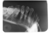Figure 74 - Posterior Oblique Mandibular Occlusal Image