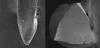 Fig 7. Scanning electron microscope (SEM) demonstrating a non-cutting file tip (left) and a convex triangular cross-section of the Dia-X file (right). Other examples of files include Hyflex and TF Adaptive.