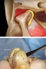 Figure 14  Lateral disc displacement with intact medial condyle-disc relationship.