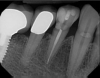 Fig 1. Multiple restorations decrease enamel and dentin strength, requiring full-coverage enhancement.