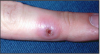 Figure 3 – Herpes whitlow lesion. Used with permission, Copyright 2006 Martin S. Spiller, D.M.D. courtesy of Dr.
Ed Cataldo