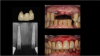 Fig 6. Ti-base abutments were seated and verified with a periapical radiograph, and a PMMA provisional placed on the same day and secured by screw retention.