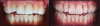 Fig 4. Left: This intraoral photograph taken with only a smartphone shows image distortion and poor color rendering. Right: This intraoral photograph was taken with a DSLR camera with an external flash and is much higher quality.