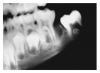 Fig 5. Mixed Dentition. Image courtesy of Lippincott, Williams & Wilkins. 2003.