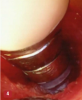 Fig 4. This videoscope image of an implant being treated for peri-implantitis demonstrates the clarity and accuracy of the videoscope image on the surgical monitor. Its high magnification (up to 40x) allows visualization of surgical details not possible with other methods of visualization.