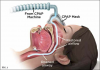 CPAP therapy involves the application of mild air pressure on a continuous basis, which
maintains airway patency by preventing the soft tissues from collapsing.