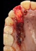 10. Tooth No. 8 with diagnosis of Grade III socket, requiring extraction followed by guided bone regeneration and a rotated pedicle flap to gain hard and soft tissue for future implant placement.
