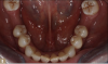 Fig 8. Opposing natural dentition.
